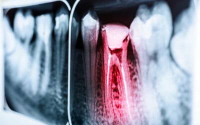 Everything You Need to Know About Root Canals